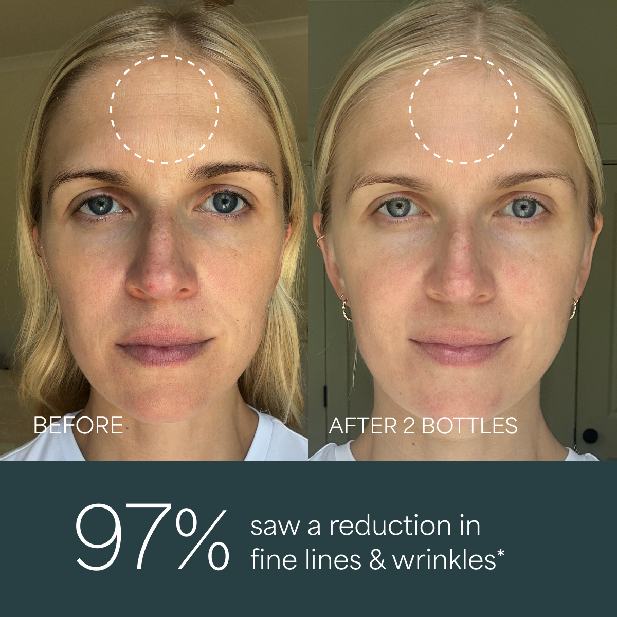 Derma Botanica Overnight Repair Serum before and after comparison in the reduction of fine lines and wrinkles.